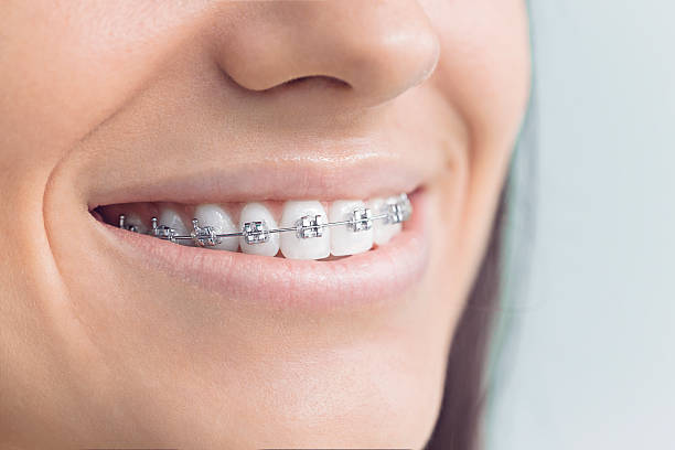 Dental Bonding in Coral Springs, FL
